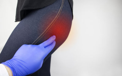 What is Piriformis Syndrome?