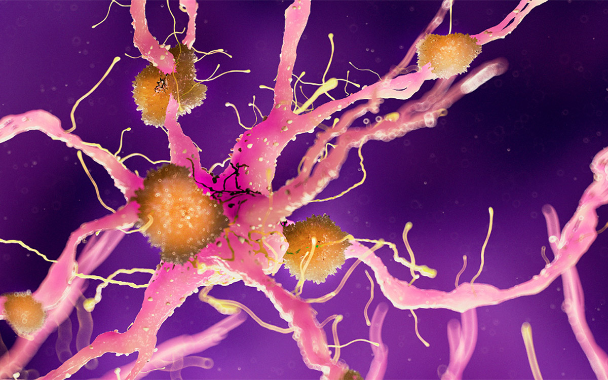 Picture of damaged nerve cell : 6 signs you may have nerve damage.