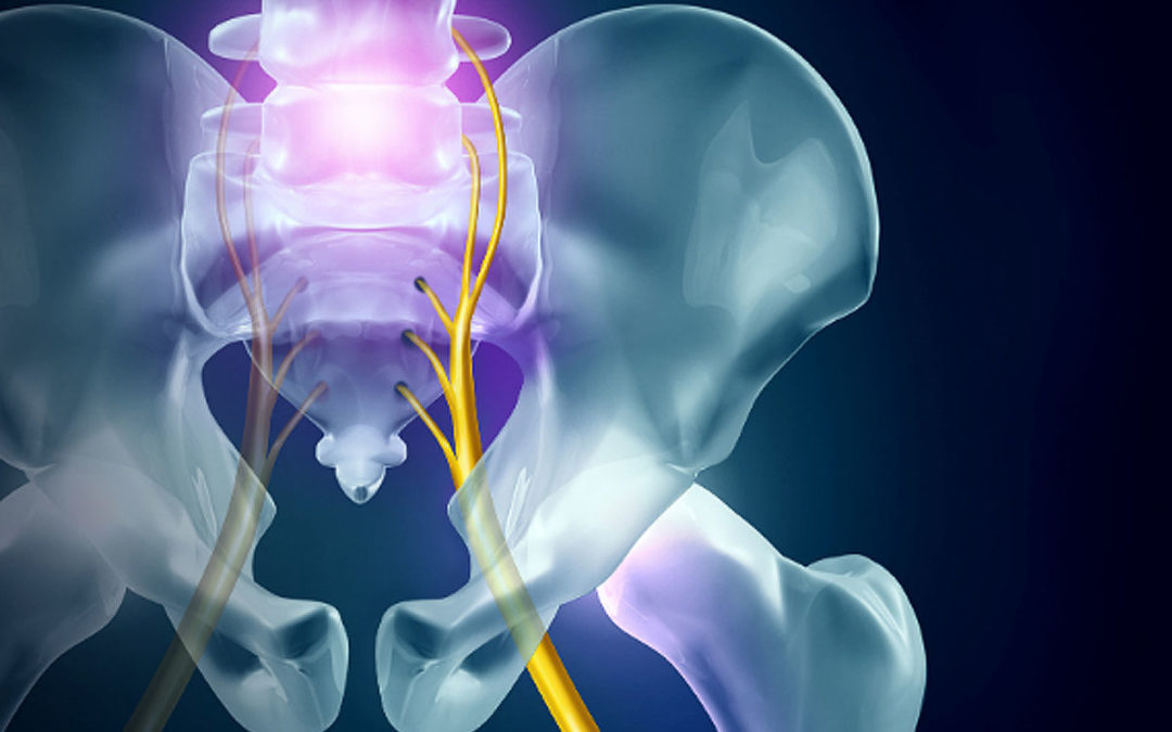Could Surgery Be The Quickest Path to Sciatica Relief?